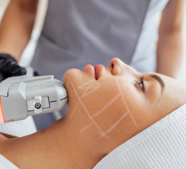 20% sleva na HIFU ošetření image