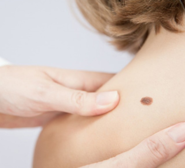 Odstranění a vyšetření znamének image