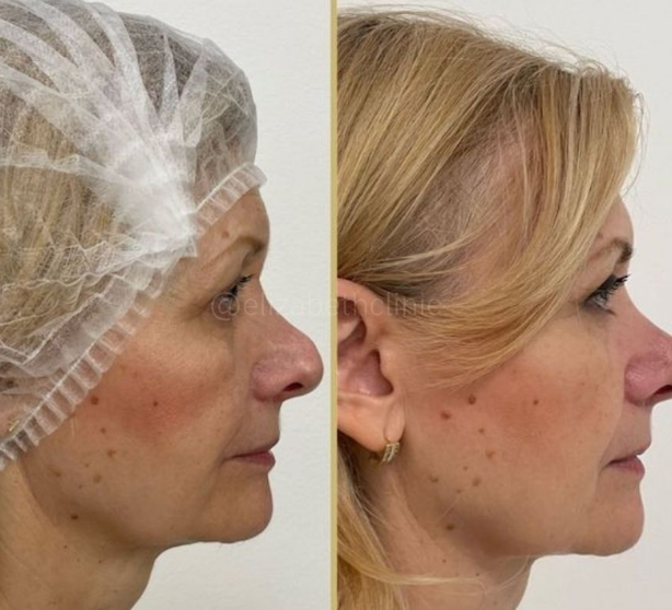 Endolift se slevou 10 % – přirozené zpevnění a omlazení bez chirurgie image